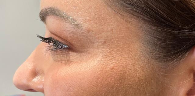 Botox after at San Diego Aesthetics and Med Spa in La Mesa, CA