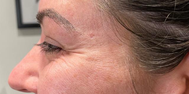 Botox before at San Diego Aesthetics and Med Spa in La Mesa, CA
