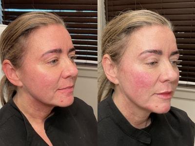 Juvederm result at Epiphany Clinic in American Fork, UT
