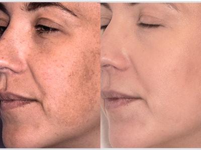 Epiphany Clinic photofacial result — American Fork, UT
