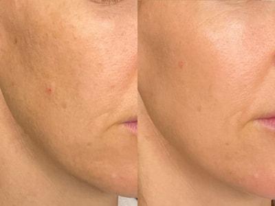 Laser Skin Resurfacing result at Epiphany Clinic in American Fork, UT