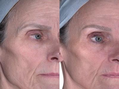 Epiphany Clinic photofacial result — American Fork, UT