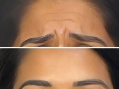 Epiphany Clinic botox result — American Fork, UT