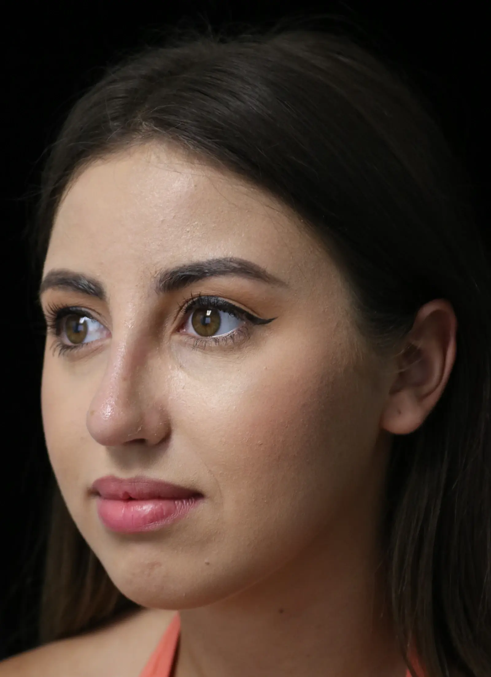 ScarlessNose - Dr. Deepak Dugar rhinoplasty after — Beverly Hills, CA