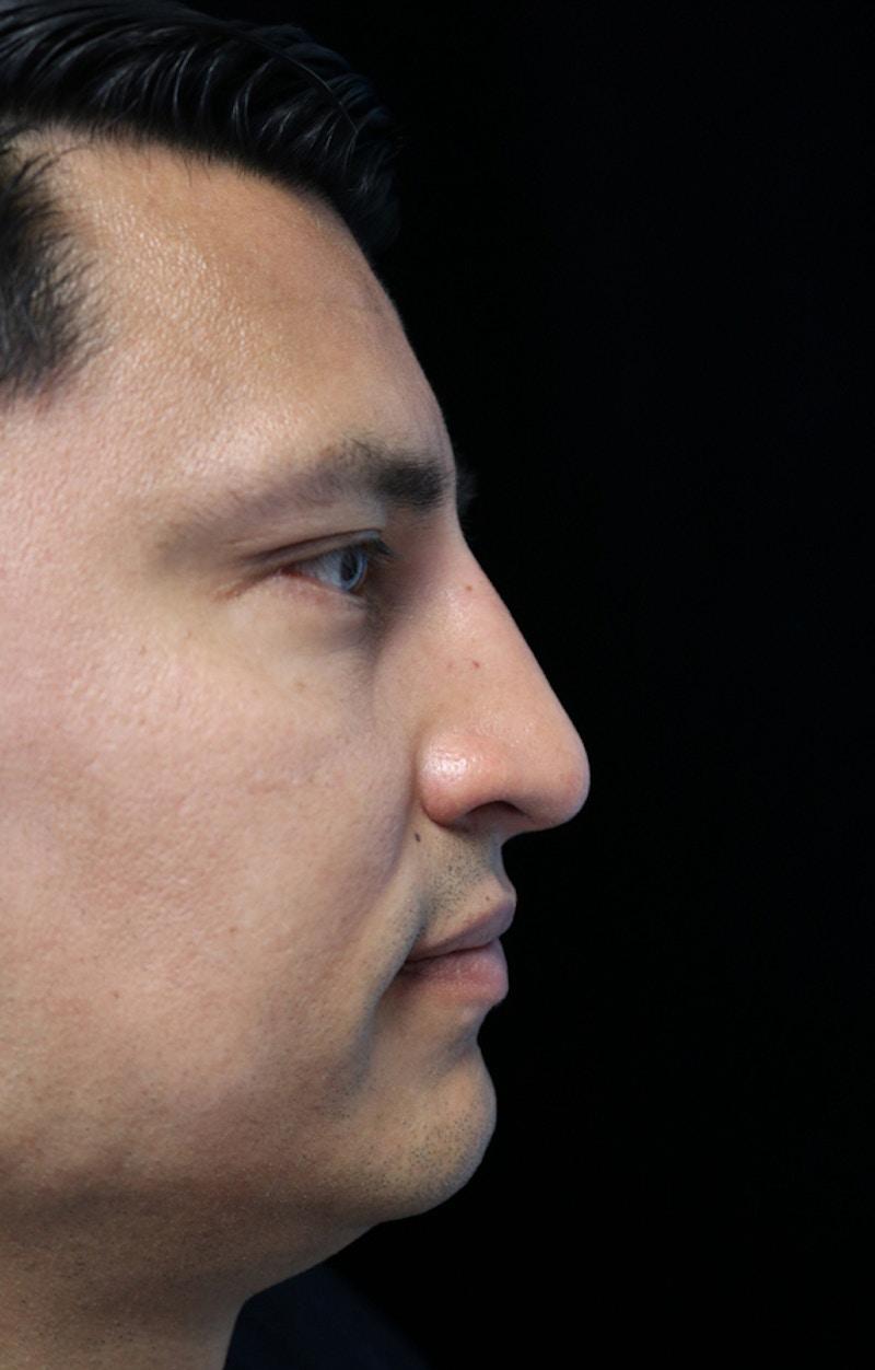 ScarlessNose - Dr. Deepak Dugar rhinoplasty after — Beverly Hills, CA