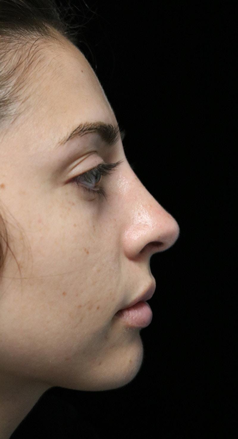 ScarlessNose - Dr. Deepak Dugar rhinoplasty after — Beverly Hills, CA