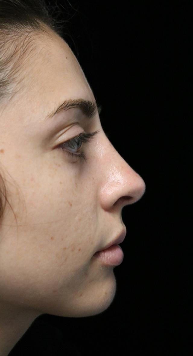 Rhinoplasty after at ScarlessNose - Dr. Deepak Dugar in Beverly Hills, CA