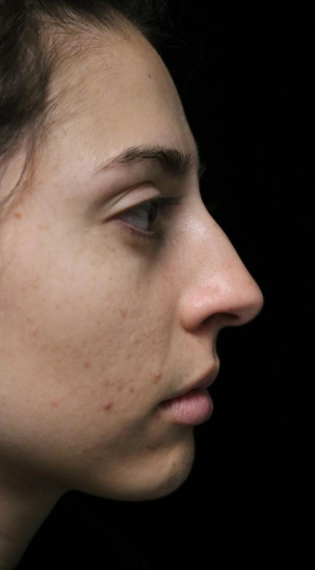 Rhinoplasty before at ScarlessNose - Dr. Deepak Dugar in Beverly Hills, CA