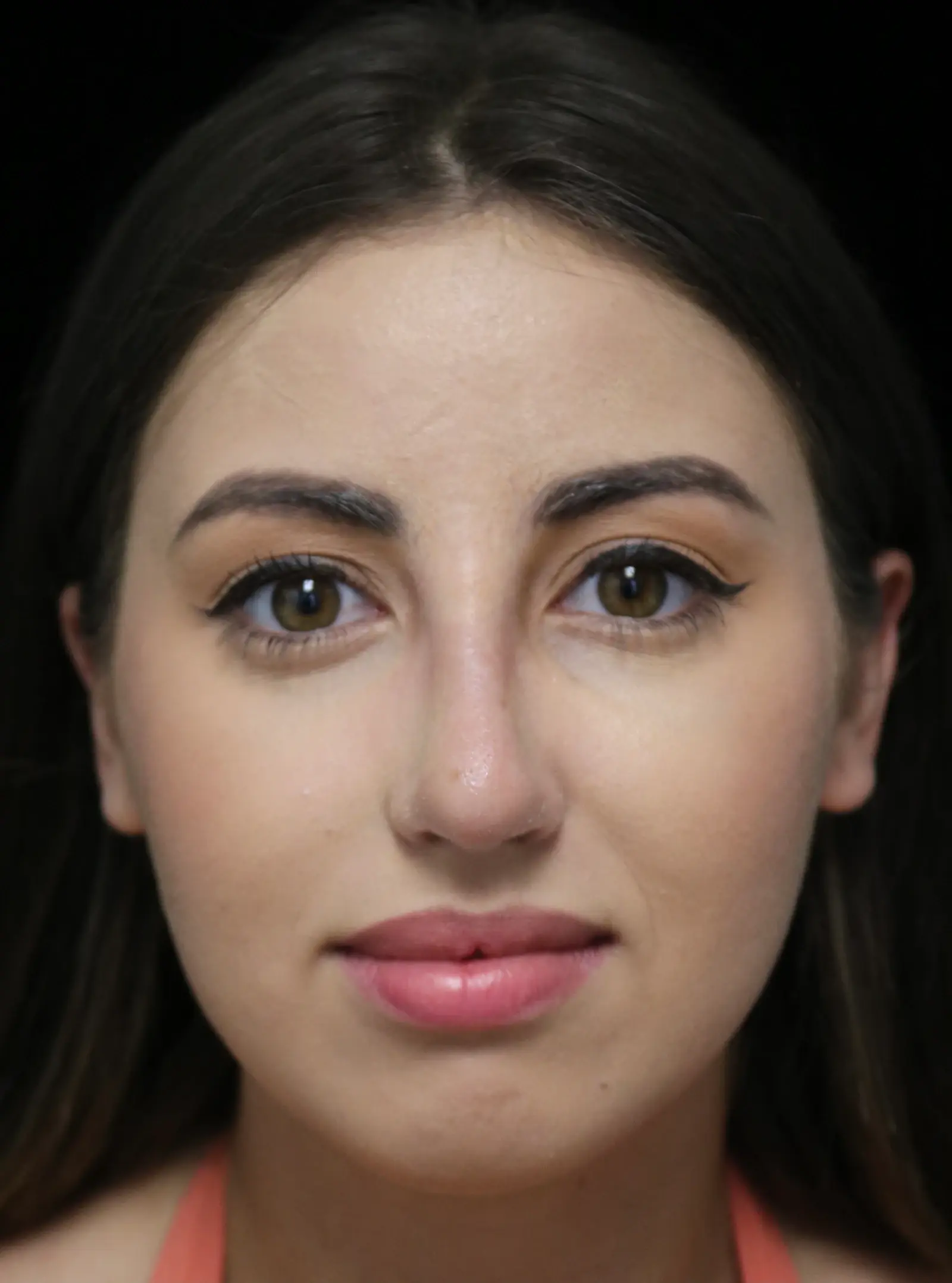 ScarlessNose - Dr. Deepak Dugar rhinoplasty after — Beverly Hills, CA