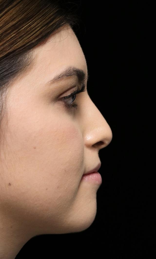 Rhinoplasty after at ScarlessNose - Dr. Deepak Dugar in Beverly Hills, CA