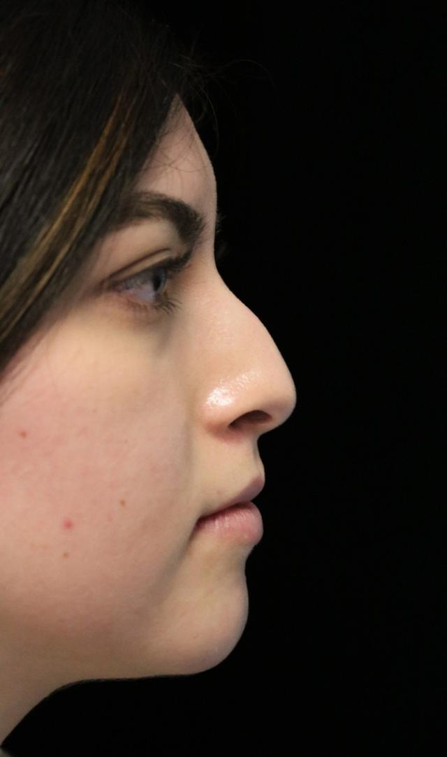 Rhinoplasty before at ScarlessNose - Dr. Deepak Dugar in Beverly Hills, CA