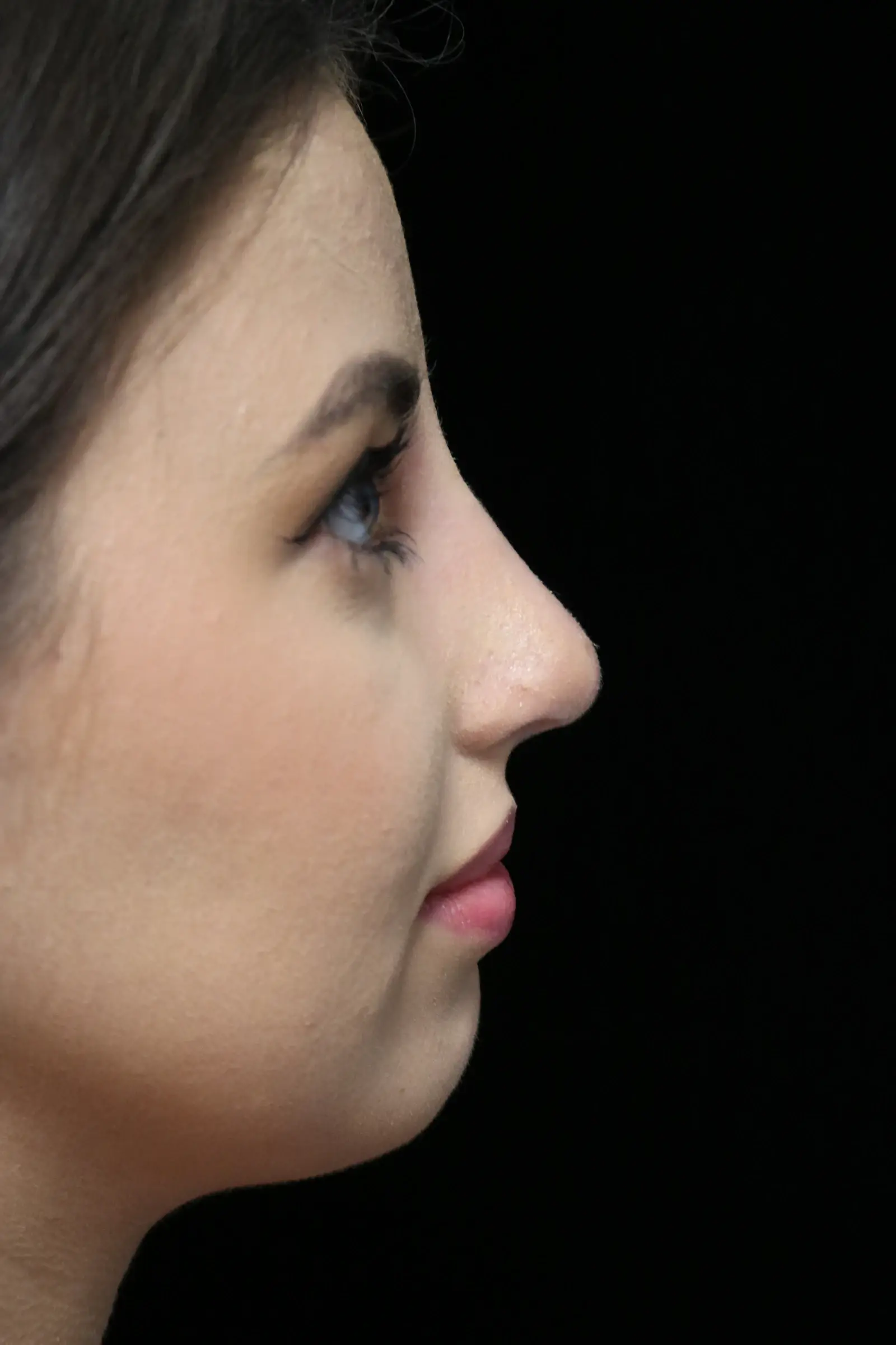 ScarlessNose - Dr. Deepak Dugar rhinoplasty after — Beverly Hills, CA