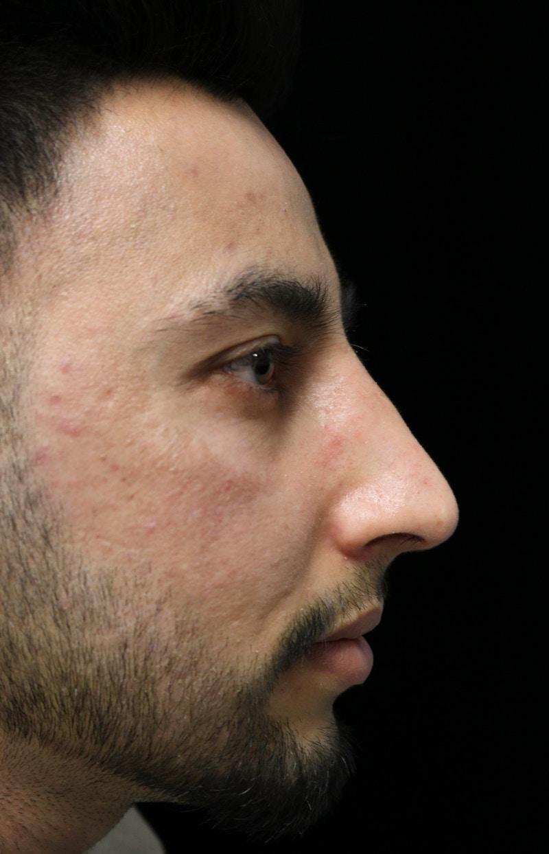ScarlessNose - Dr. Deepak Dugar rhinoplasty after — Beverly Hills, CA