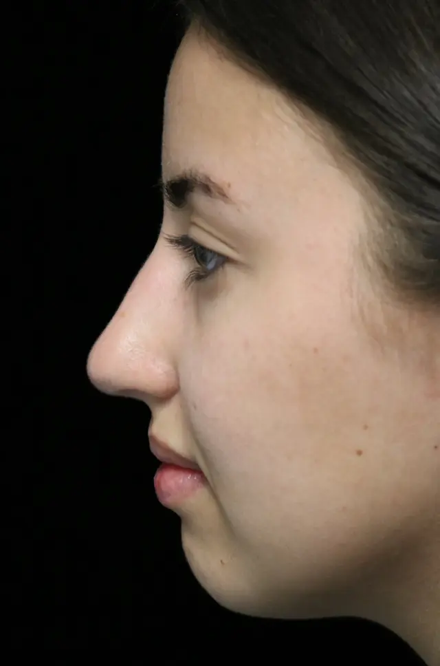 Functional Rhinoplasty before at ScarlessNose - Dr. Deepak Dugar in Beverly Hills, CA
