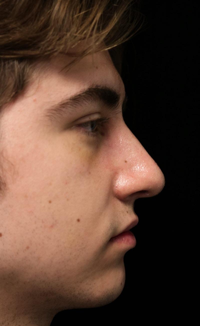 ScarlessNose - Dr. Deepak Dugar rhinoplasty after — Beverly Hills, CA