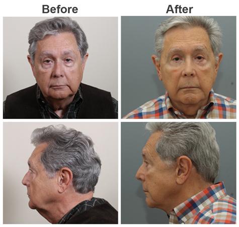 Facelift result at Zubowicz Plastic Surgery in Atlanta, GA