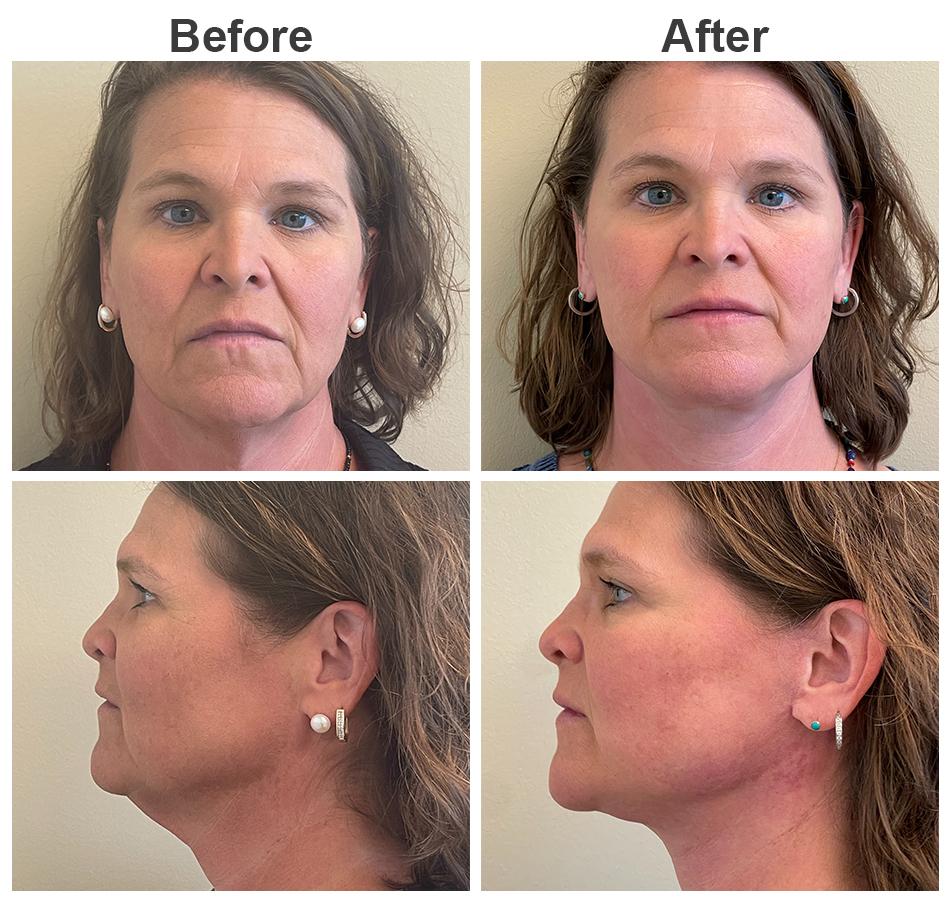 Zubowicz Plastic Surgery facelift result — Atlanta, GA