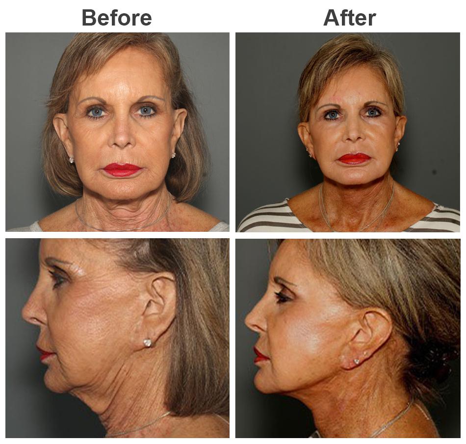 Zubowicz Plastic Surgery facelift result — Atlanta, GA