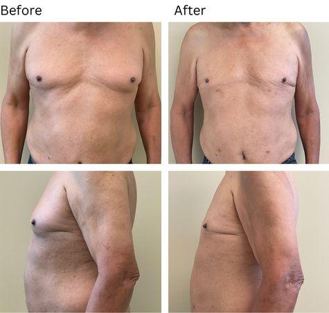 Gynecomastia Surgery result at Zubowicz Plastic Surgery in Atlanta, GA