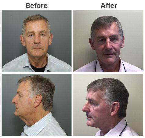 Zubowicz Plastic Surgery facelift result — Atlanta, GA