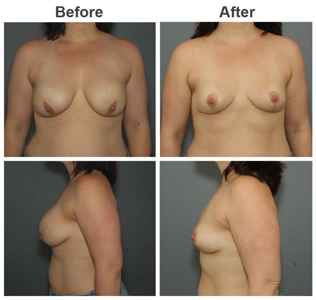 Breast Augmentation result at Zubowicz Plastic Surgery in Atlanta, GA