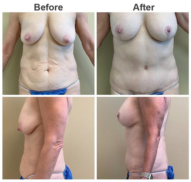 Mommy Makeover result at Zubowicz Plastic Surgery in Atlanta, GA