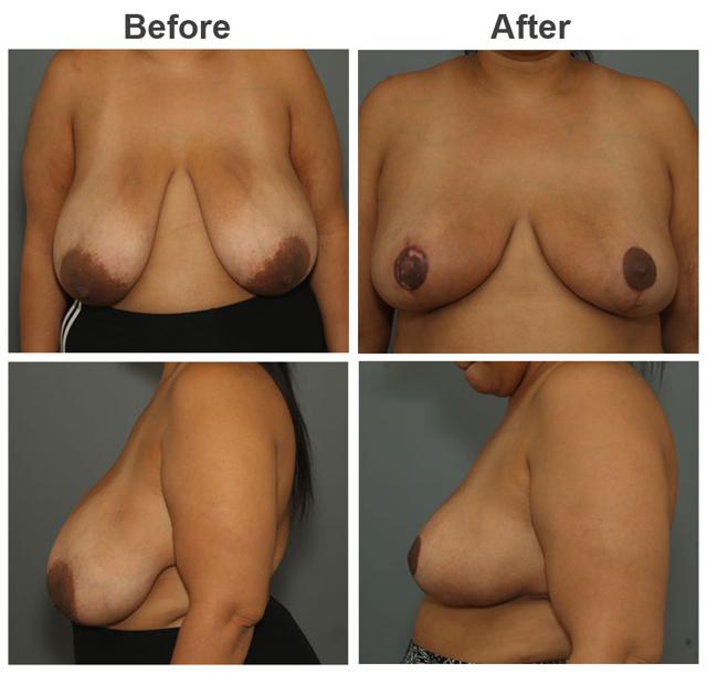 Breast Reduction result at Zubowicz Plastic Surgery in Atlanta, GA
