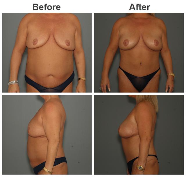 Mommy Makeover result at Zubowicz Plastic Surgery in Atlanta, GA