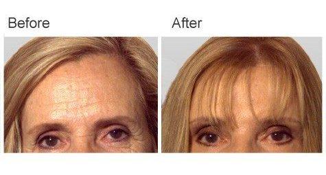 Zubowicz Plastic Surgery brow lift result — Atlanta, GA