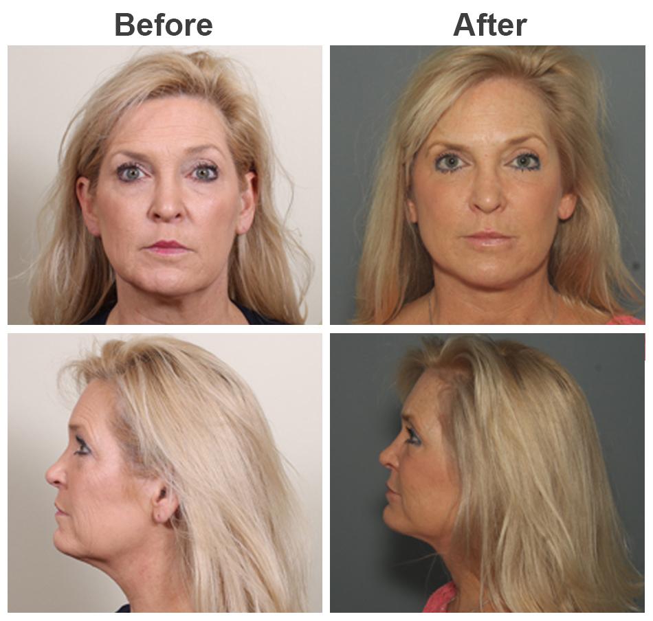 Zubowicz Plastic Surgery facelift result — Atlanta, GA