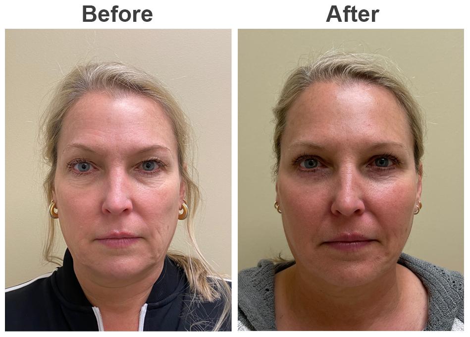 Zubowicz Plastic Surgery blepharoplasty result — Atlanta, GA
