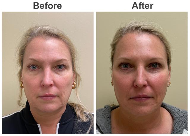 Blepharoplasty result at Zubowicz Plastic Surgery in Atlanta, GA