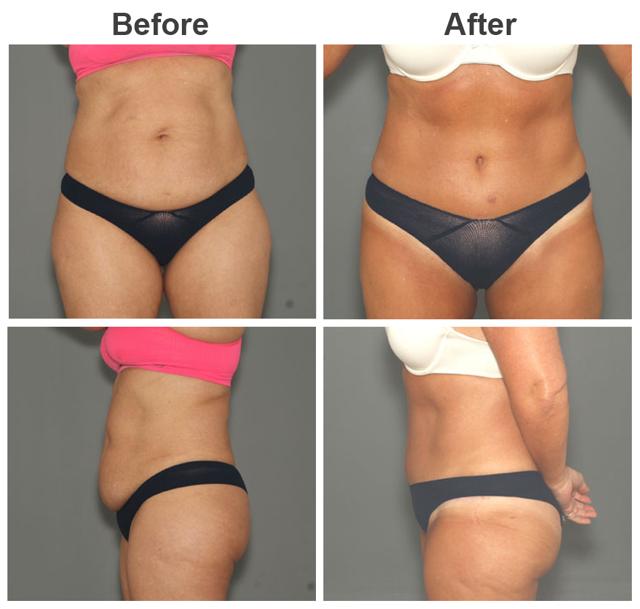 Tummy Tuck result at Zubowicz Plastic Surgery in Atlanta, GA