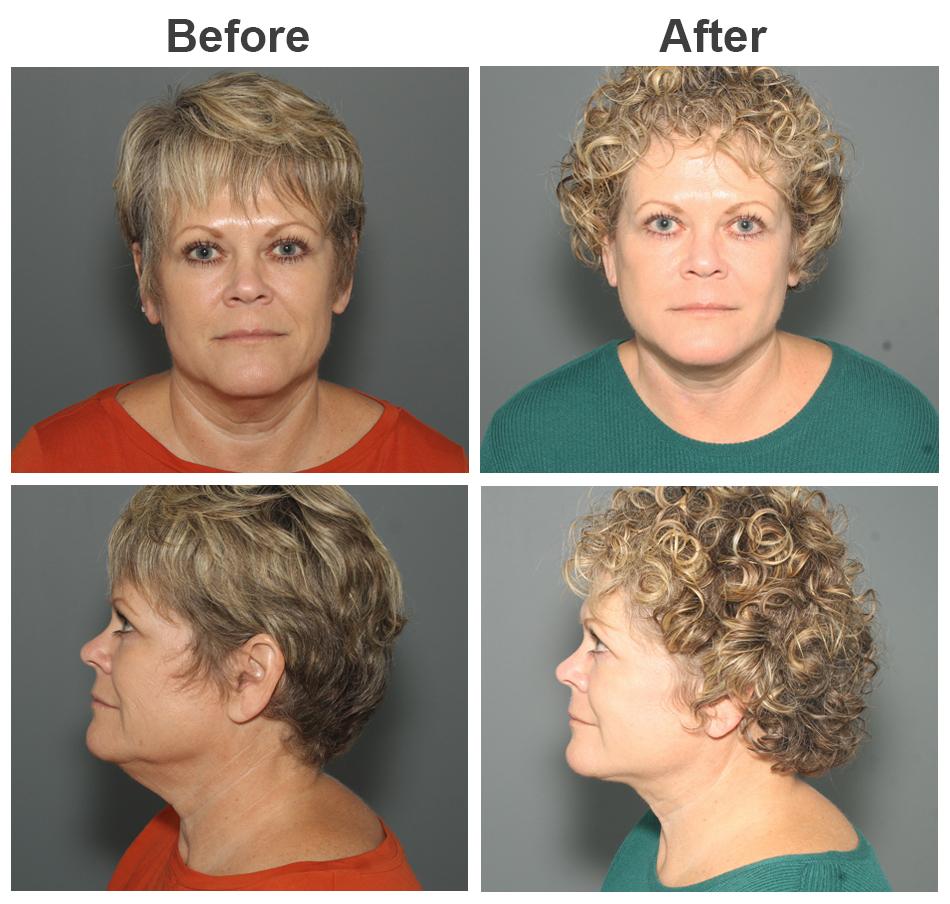 Zubowicz Plastic Surgery facelift result — Atlanta, GA