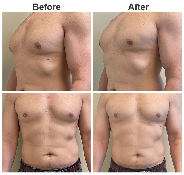 Gynecomastia Surgery result at Zubowicz Plastic Surgery in Atlanta, GA