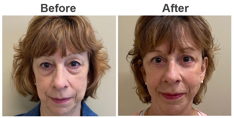 Zubowicz Plastic Surgery blepharoplasty result — Atlanta, GA