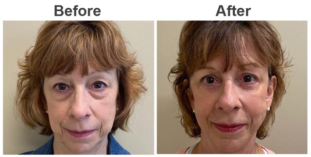 Blepharoplasty result at Zubowicz Plastic Surgery in Atlanta, GA