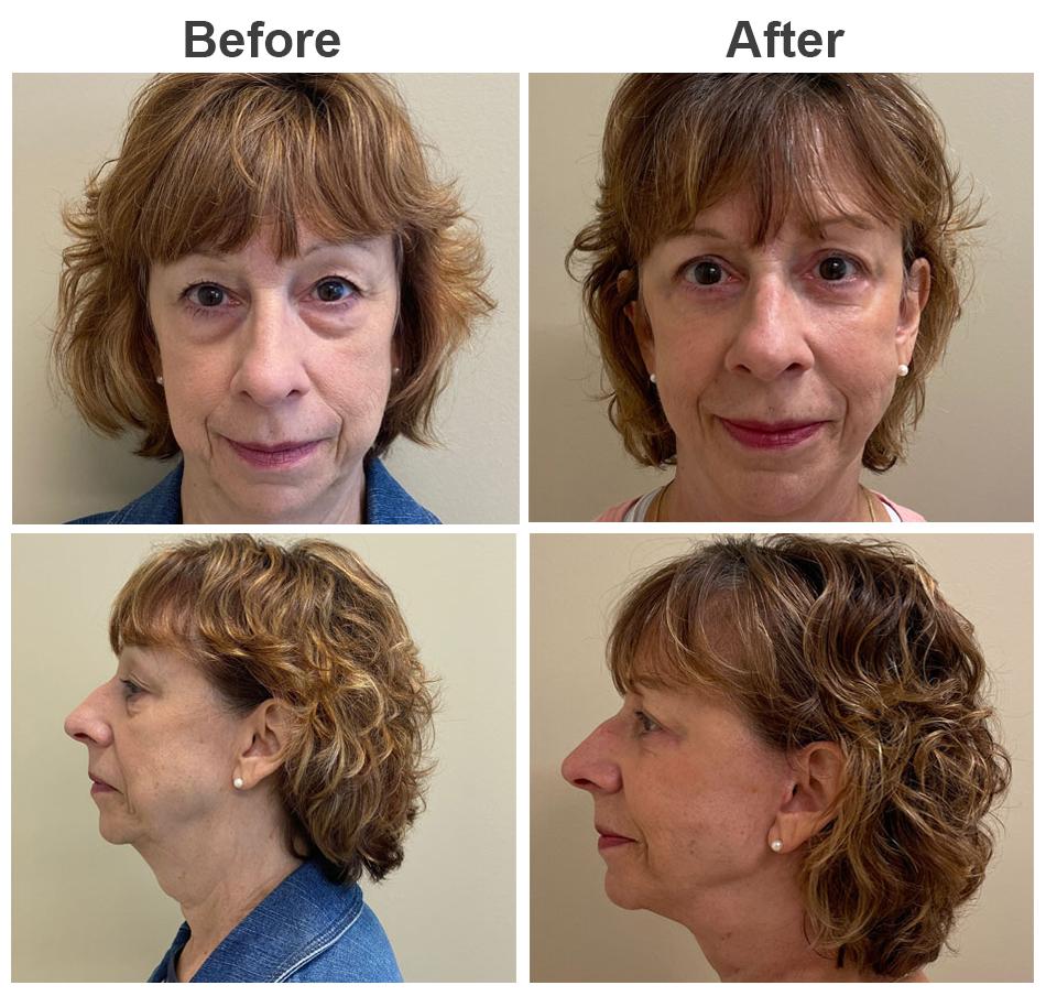 Zubowicz Plastic Surgery facelift result — Atlanta, GA