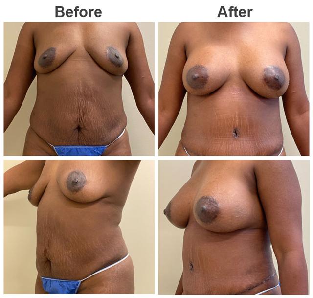 Mommy Makeover result at Zubowicz Plastic Surgery in Atlanta, GA