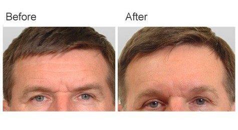 Zubowicz Plastic Surgery brow lift result — Atlanta, GA