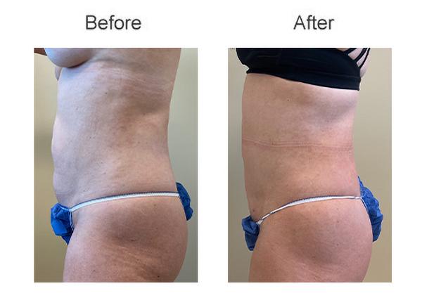 Liposuction result at Zubowicz Plastic Surgery in Atlanta, GA