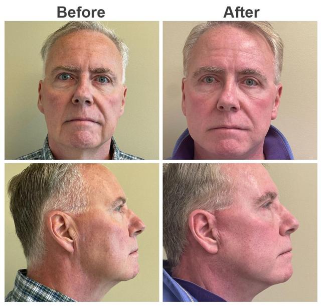Facelift result at Zubowicz Plastic Surgery in Atlanta, GA