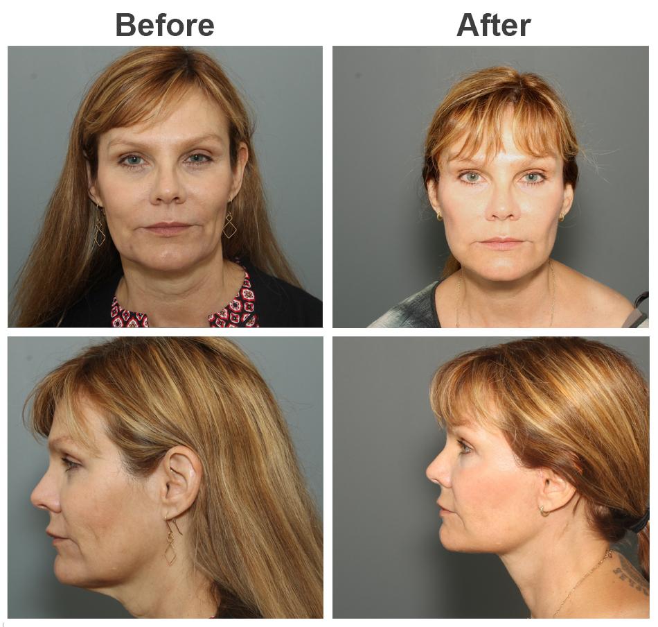 Zubowicz Plastic Surgery facelift result — Atlanta, GA