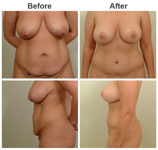 Mommy Makeover result at Zubowicz Plastic Surgery in Atlanta, GA