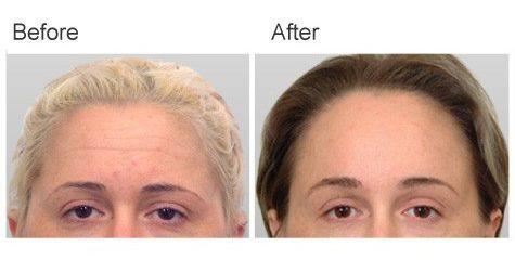 Zubowicz Plastic Surgery brow lift result — Atlanta, GA