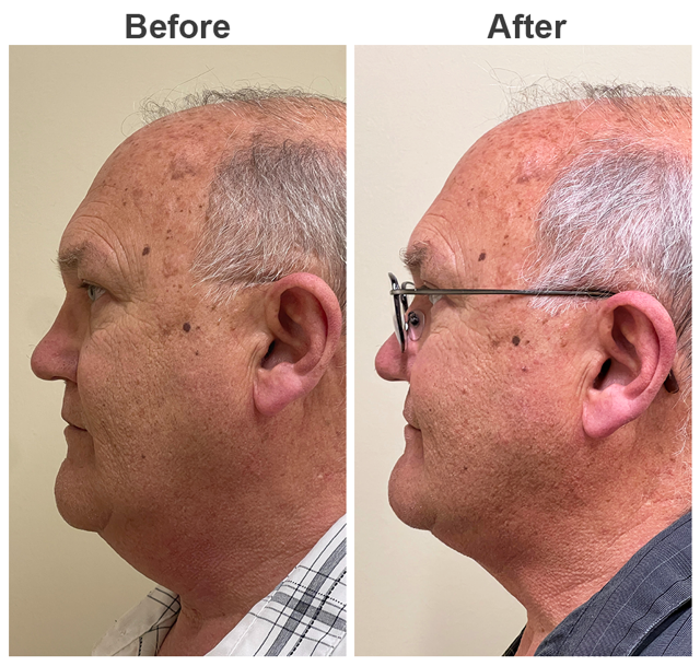 Liposuction result at Zubowicz Plastic Surgery in Atlanta, GA