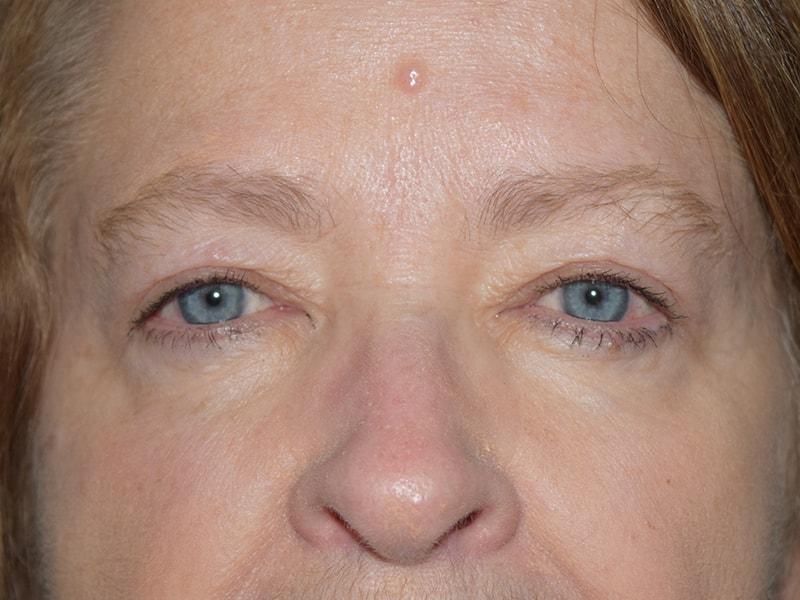 Meghan Nadeau, MD eyelid lift after — Seattle, WA