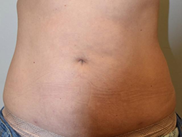 Liposuction after at Meghan Nadeau, MD in Seattle, WA