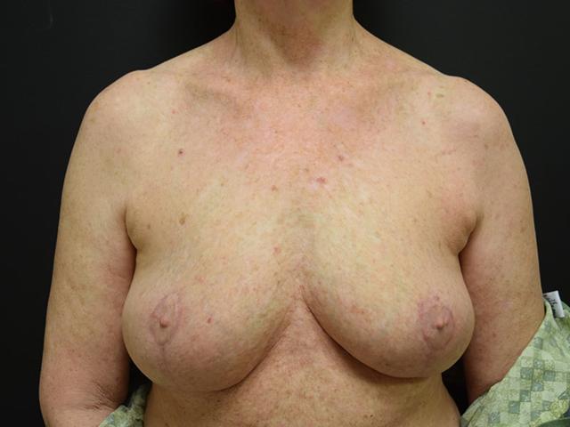 Breast Reduction after at Meghan Nadeau, MD in Seattle, WA