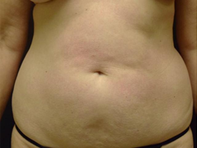 Liposuction before at Meghan Nadeau, MD in Seattle, WA